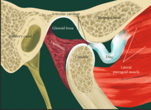 TMJ Disc Displacement with and without Reduction: Diagnosis, Treatment ...