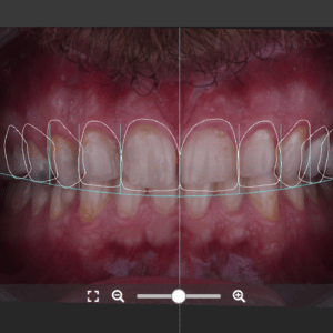 2D-3D Digital Smile Design Workflow