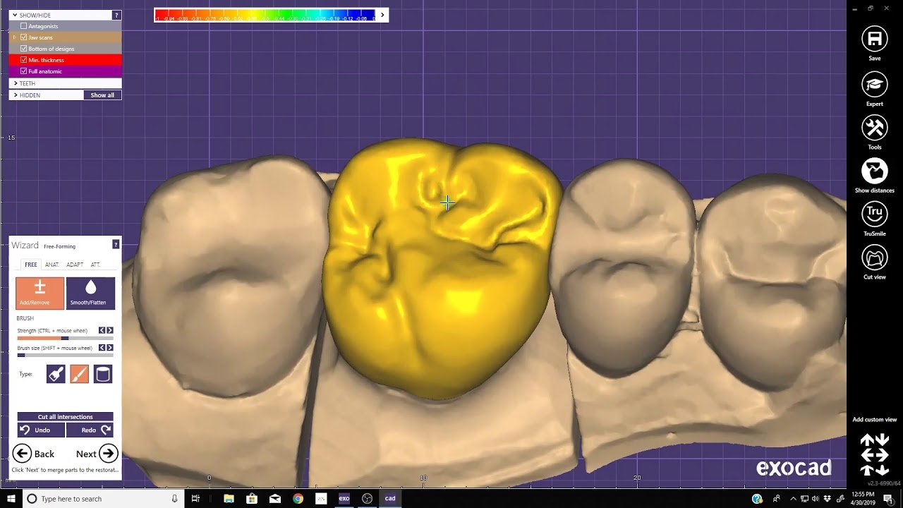 exocad crown Design CADCAM