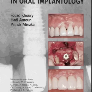 Bone Augmentation in oral implantology - Fouad khoury