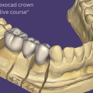 Mastering exocad crown module " Live course"
