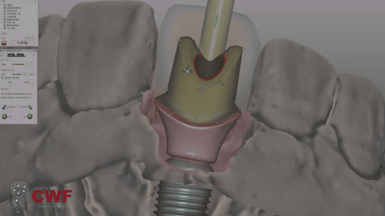 Custom Abutment Design Course- Arabic Version by Dr. Haitham Sharshar | exocad Online Training Course