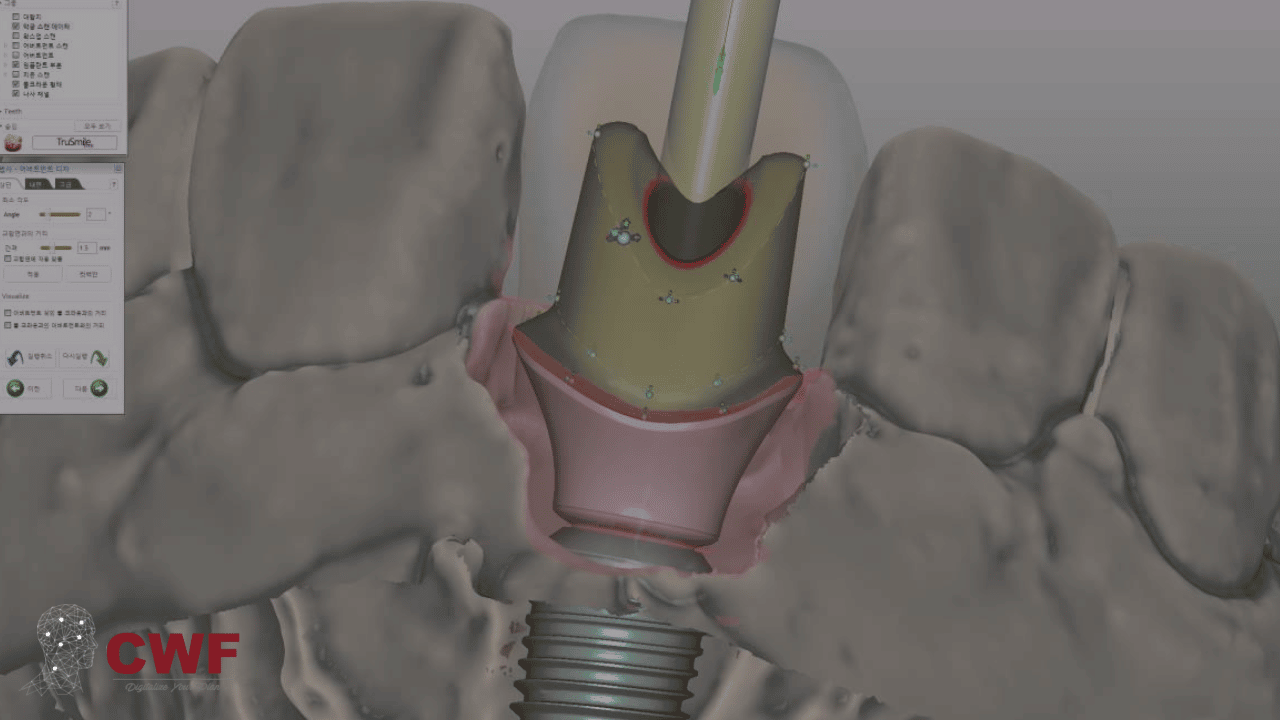 Custom Abutment Design Course- Arabic Version by Dr. Haitham Sharshar | exocad Online Training Course