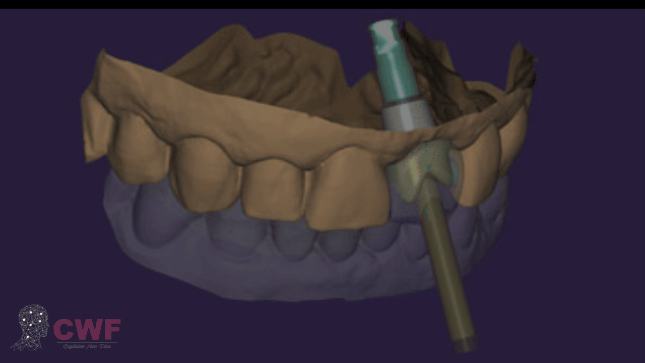 Screw Retained Design