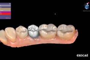 Crown & Bridge (2023)