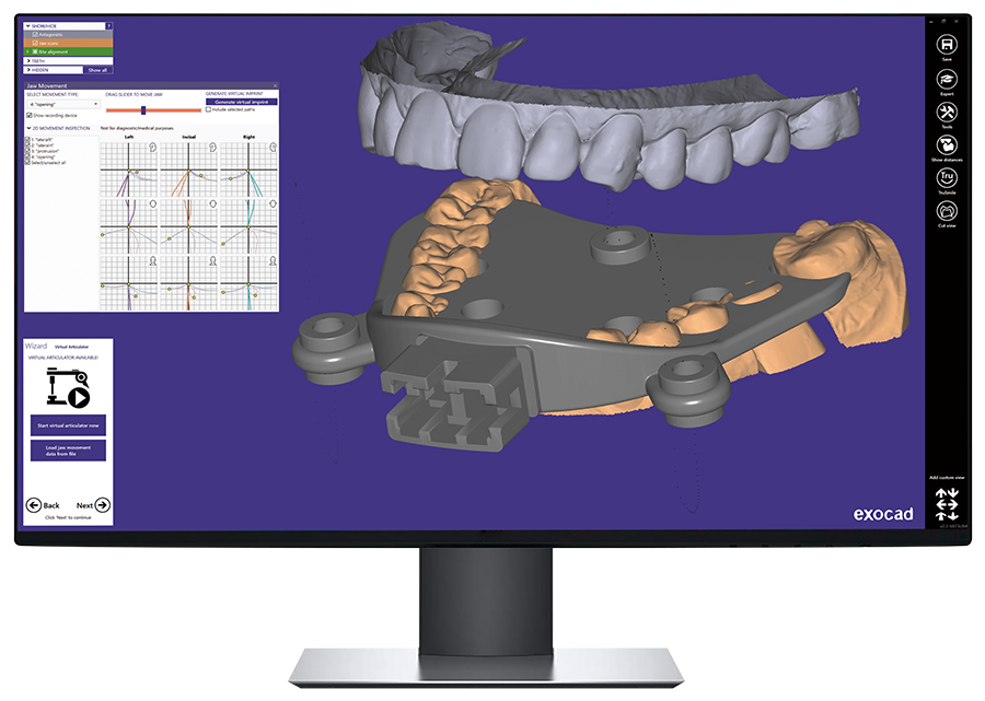 digital jaw tracking integration between zebris -exocad