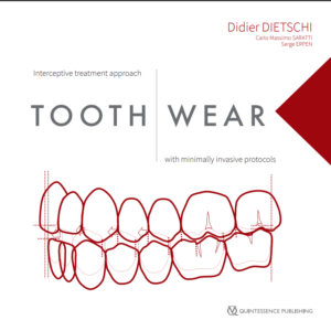 Tooth Wear Interceptive treatment approach with minimally invasive protocols