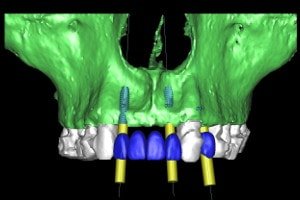 Implant Private course