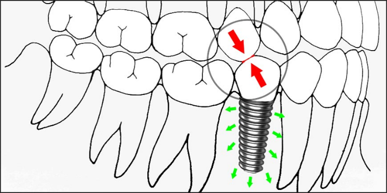 Dynamic Abutments & AI in Implantology 3 3 2