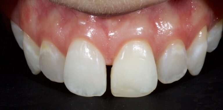 Managing Midline Diastemas with Aesthetic Restorations: Contemporary Approaches in Cosmetic Prosthodontics