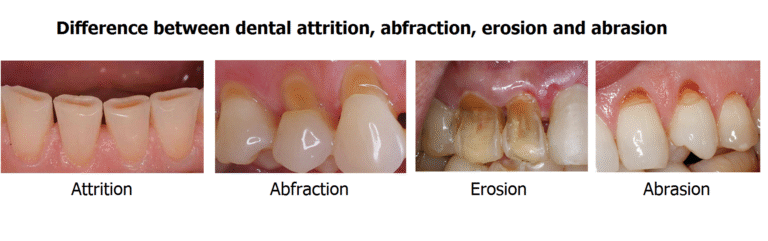 Tooth Wear: Causes, Management, and Treatment Plans for Modern Dental Practice