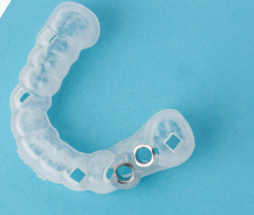 Digital Implant Planning with Surgical Guides: A Comprehensive Guide for Modern Dentistry 1 1 35