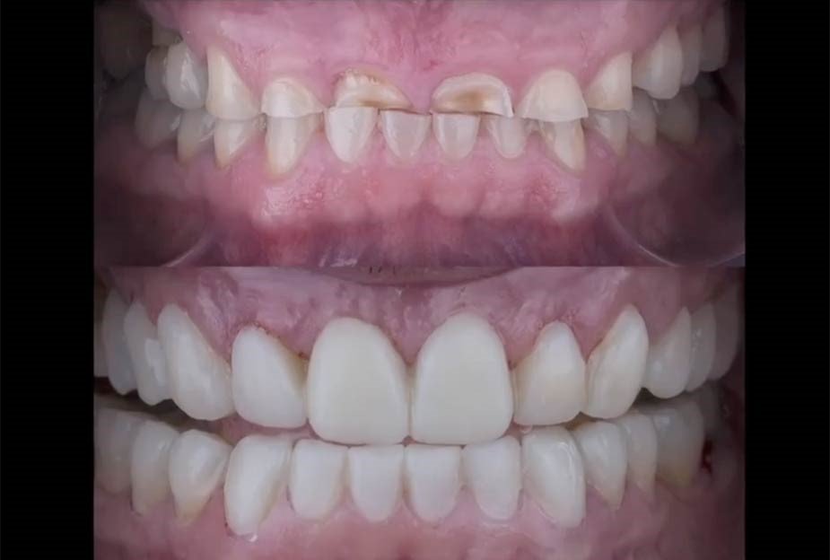 Digital Mock-Ups in Aesthetic and Cosmetic Prosthodontics: Treatment Planning Excellence 1 1 4