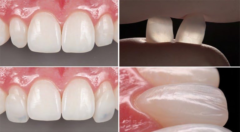 Color Matching Strategies in Anterior Restorations: The Art and Science of Aesthetic and Cosmetic Prosthodontics 1 1 5