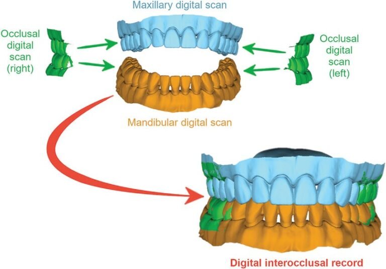 Upper and lower digital dental scans combined with right and left bite scans to create an interocclusal record
