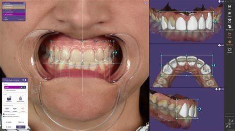 Digital Mock-Ups in Aesthetic and Cosmetic Prosthodontics: Treatment Planning Excellence 10 10 1