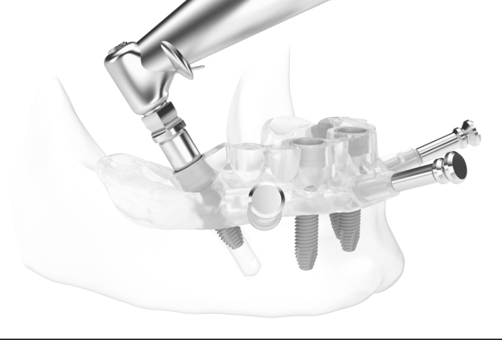 Digital Implant Planning with Surgical Guides: A Comprehensive Guide for Modern Dentistry 10 10 3