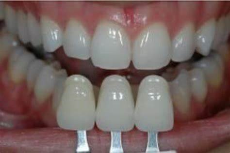 Digital Photography in Aesthetic Evaluation: A Game-Changer for Aesthetic and Cosmetic Prosthodontics 10 10