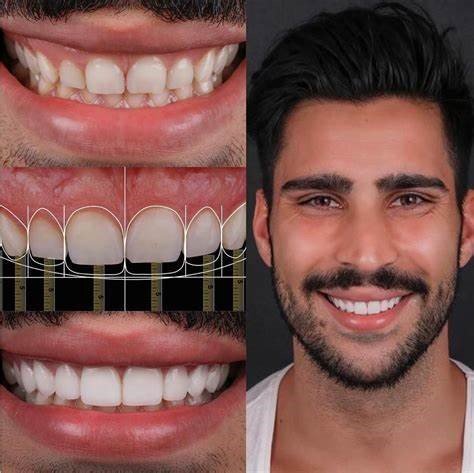 Digital Photography in Aesthetic Evaluation: A Game-Changer for Aesthetic and Cosmetic Prosthodontics 15 11