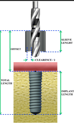 Digital Implant Planning with Surgical Guides: A Comprehensive Guide for Modern Dentistry 12 12 3