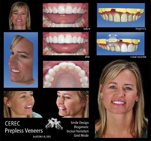 Managing Midline Diastemas with Aesthetic Restorations: Contemporary Approaches in Cosmetic Prosthodontics 38 13 5