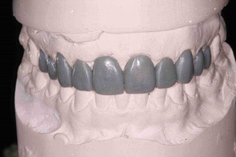 Digital Mock-Ups in Aesthetic and Cosmetic Prosthodontics: Treatment Planning Excellence 20 Digital Mock-Ups in Aesthetic and Cosmetic Prosthodontics: Treatment Planning Excellence