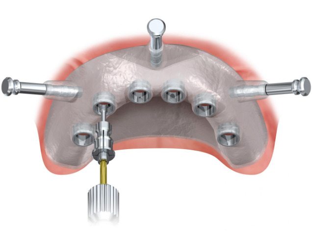 Digital Implant Planning with Surgical Guides: A Comprehensive Guide for Modern Dentistry 3 3 37