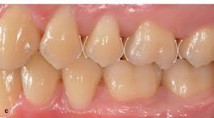 Posterior teeth occlusion showing proper interproximal contacts and marginal ridge alignment