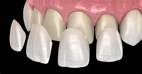 Zirconia vs Ceramics in Modern Dentistry: A Comprehensive Comparison 3 4 14
