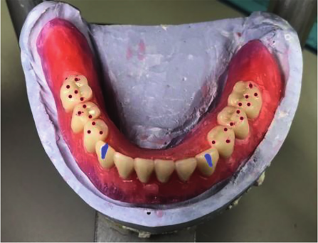 Complete denture setup with wax try-in for mandibular arch showing balanced occlusion and prosthetic tooth placement