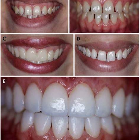 Zirconia vs Ceramics in Modern Dentistry: A Comprehensive Comparison 4 5 13