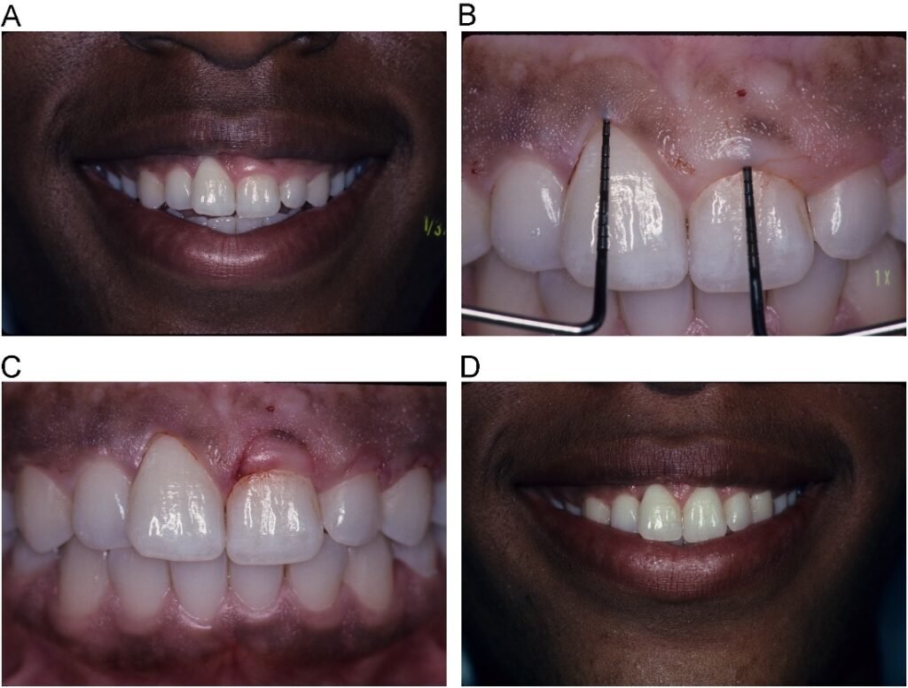 Managing Tooth Proportions for Harmonious Smiles: A Comprehensive Guide to Aesthetic and Cosmetic Prosthodontics 5 5 28
