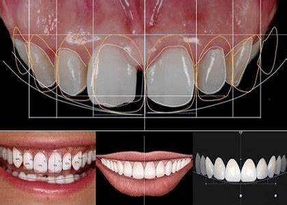 Digital Mock-Ups in Aesthetic and Cosmetic Prosthodontics: Treatment Planning Excellence 5 5 5