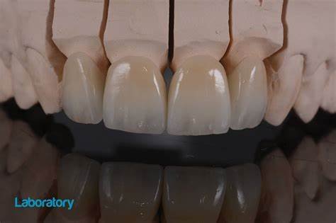 Zirconia vs Ceramics in Modern Dentistry: A Comprehensive Comparison 5 6 12