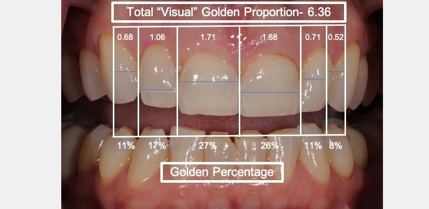 Patient-Centered Aesthetic Treatment Planning in Cosmetic Prosthodontics: A Comprehensive Approach 5 6 8