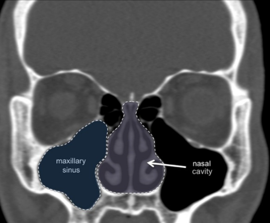 Digital Implant Planning with Surgical Guides: A Comprehensive Guide for Modern Dentistry 7 7 17