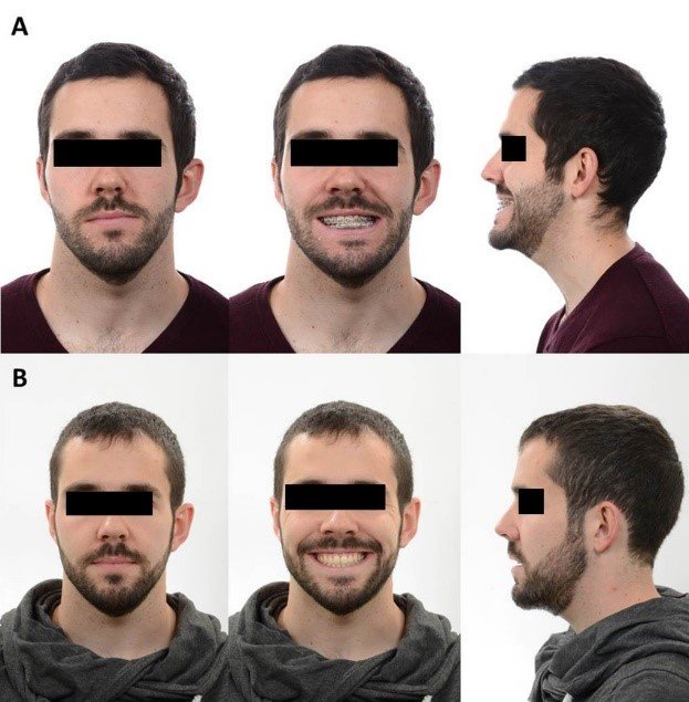 Digital Photography in Aesthetic Evaluation: A Game-Changer for Aesthetic and Cosmetic Prosthodontics 7 7 4