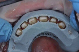 Digital Mock-Ups in Aesthetic and Cosmetic Prosthodontics: Treatment Planning Excellence 7 7 5