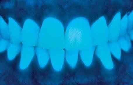 Color Matching Strategies in Anterior Restorations: The Art and Science of Aesthetic and Cosmetic Prosthodontics 7 7 6