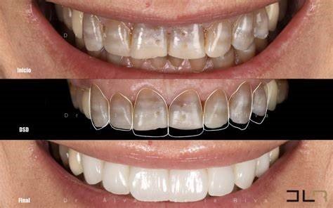 Patient-Centered Aesthetic Treatment Planning in Cosmetic Prosthodontics: A Comprehensive Approach 6 7 9