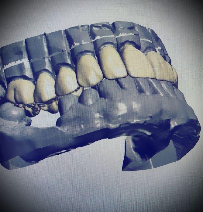 Smile Design Principles in Full Mouth Rehabilitation: Aesthetic and Cosmetic Prosthodontics 8 8 14