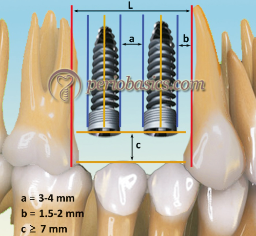 Digital Implant Planning with Surgical Guides: A Comprehensive Guide for Modern Dentistry 8 8 14