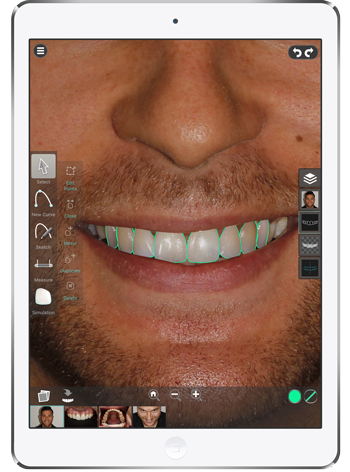 Digital Mock-Ups in Aesthetic and Cosmetic Prosthodontics: Treatment Planning Excellence 9 9 1
