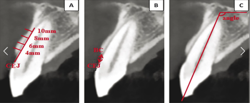 Digital Implant Planning with Surgical Guides: A Comprehensive Guide for Modern Dentistry 9 9 9