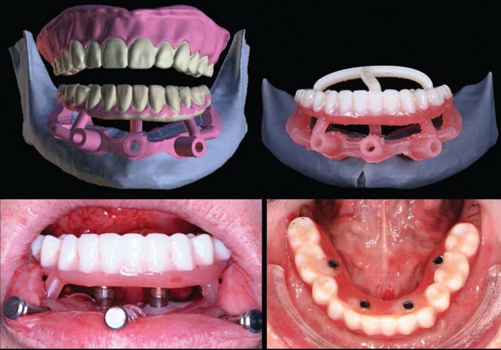 Digital implant planning and intraoral stages of full-arch prosthetic rehabilitation