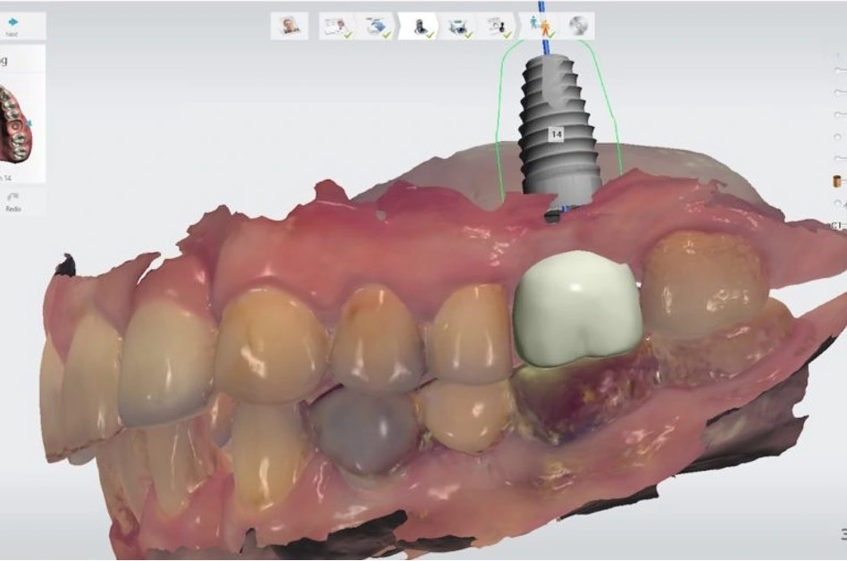 3Shape implant planning with soft tissue scan for digital implant workflow by Dr. Haitham Sharshar