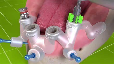 Digital Implant Planning with Surgical Guides: A Comprehensive Guide for Modern Dentistry 16 t1 1