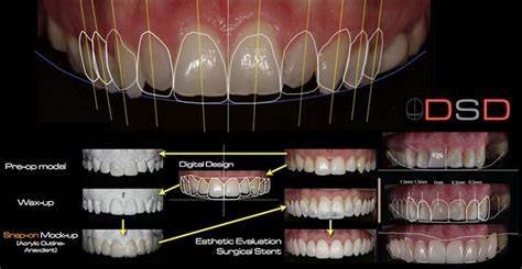 Smile Design Principles in Full Mouth Rehabilitation: Aesthetic and Cosmetic Prosthodontics 9 t1 4