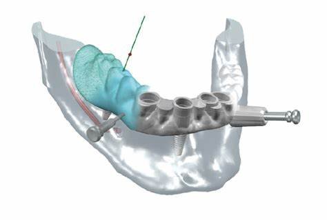 Digital Implant Planning with Surgical Guides: A Comprehensive Guide for Modern Dentistry 18 t2 2