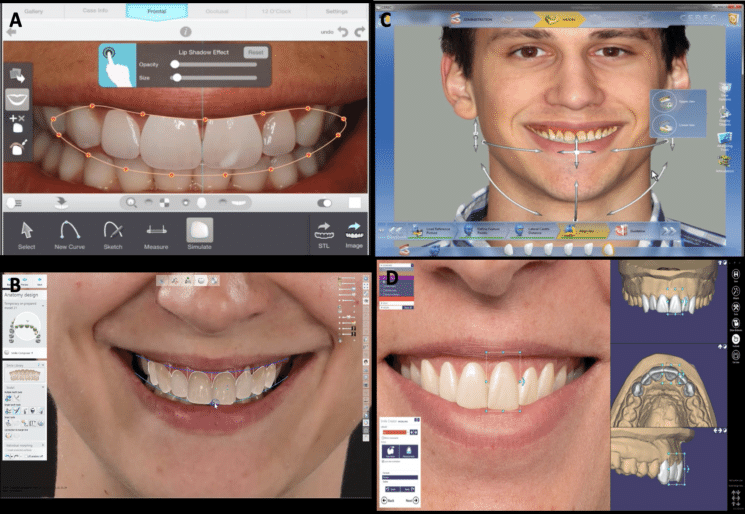 Smile Design Principles in Full Mouth Rehabilitation: Aesthetic and Cosmetic Prosthodontics 11 t2